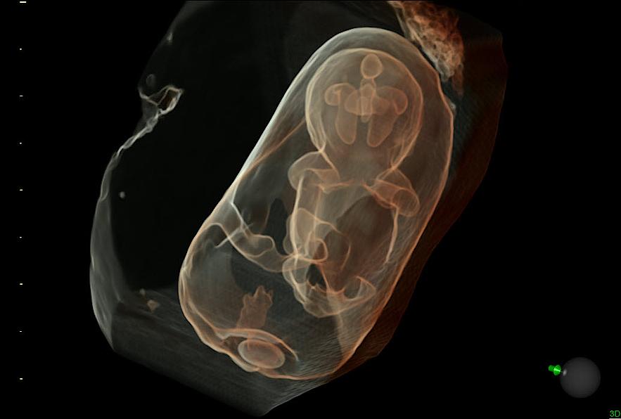 HDlive Silhouette ultrasound image