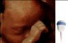 Ultrazvukový snímek plodu zachycený pomocí sondy RAB6-RS