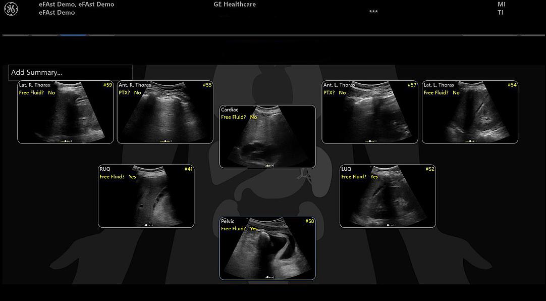 Ultrazvukový snímek přehledu diagramu eFAST s pozitivním nálezem.