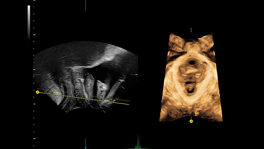 Reduce exam time by up to 75% with SonoPelvicFloor. Simplify and speed up exams with automated plane alignment and automated measurements for more consistent reproducible results.