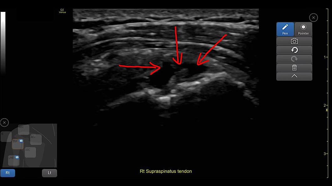 Ultrasound image captured using Scribble