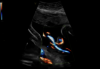 Ultrazvukový snímek zachycený pomocí funkce Radiantflow