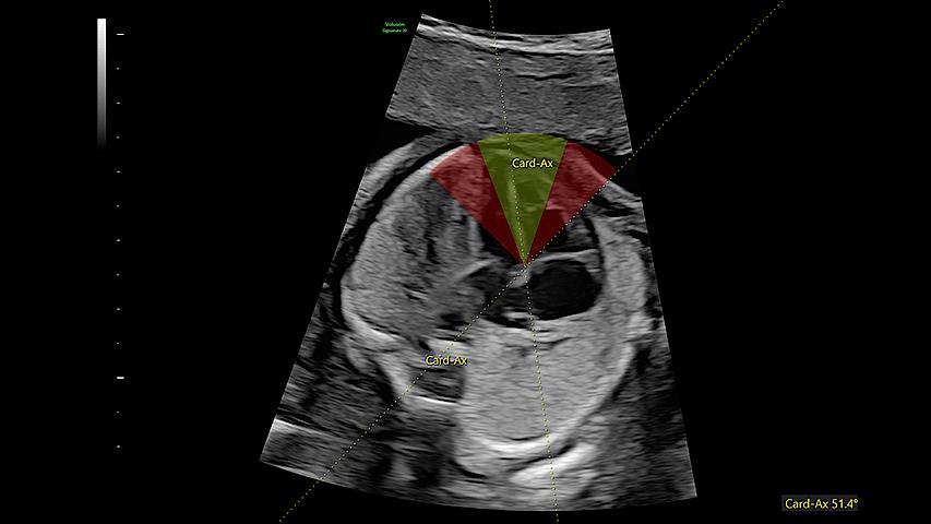 Reduce time to assess fetal heart by 48% with fetalHS. fetalHS provides a step-by-step guidance that uses AI to help identify fetal situs and normal fetal heart anatomy using the 4-Chamber Heart, 3-Vessel View/3-Vessels and Trachea View, and Cardiac Axis.