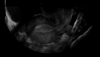 Ultrazvukový snímek dělohy zachycený pomocí funkce Free Fluid