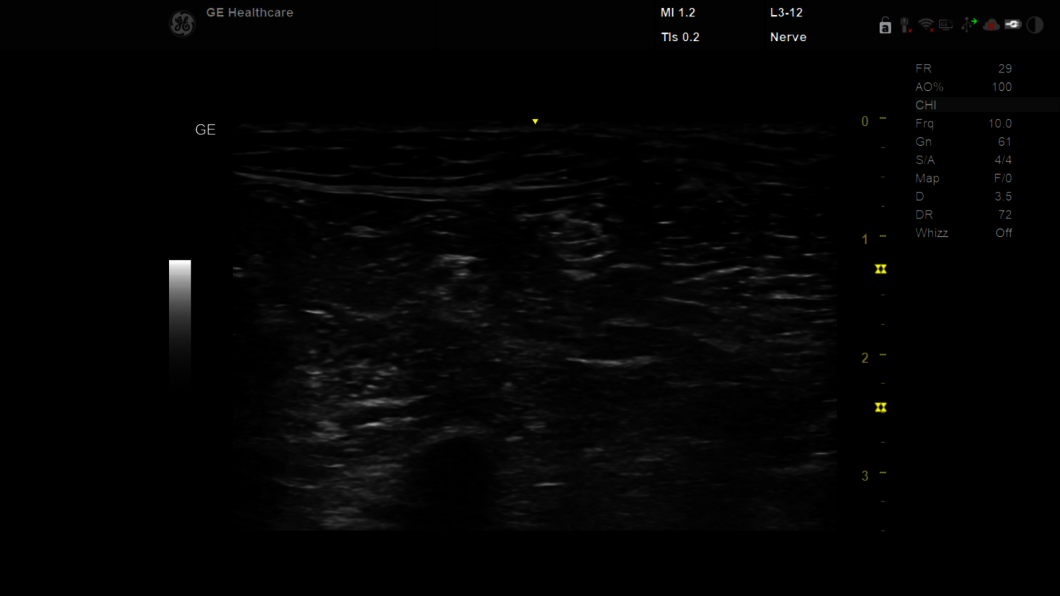Ultrazvukový snímek: L312 nerv