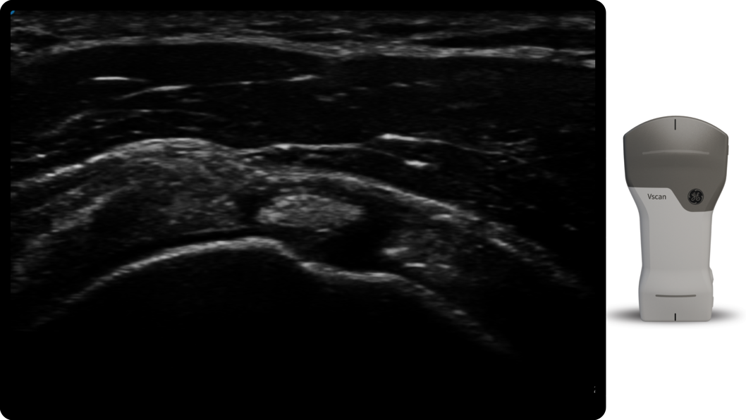 Ganglion cysts with Vscan Air CL probe