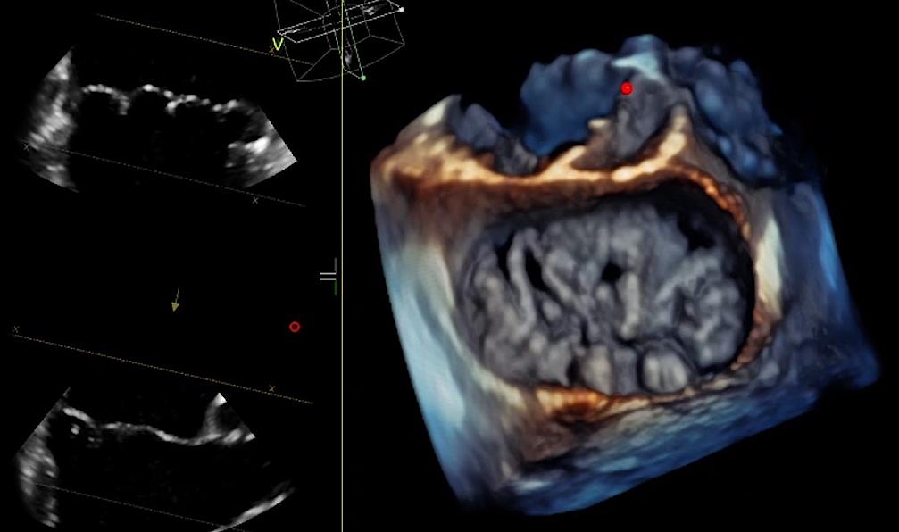 Clinical image captured with a 4D TEE-probe