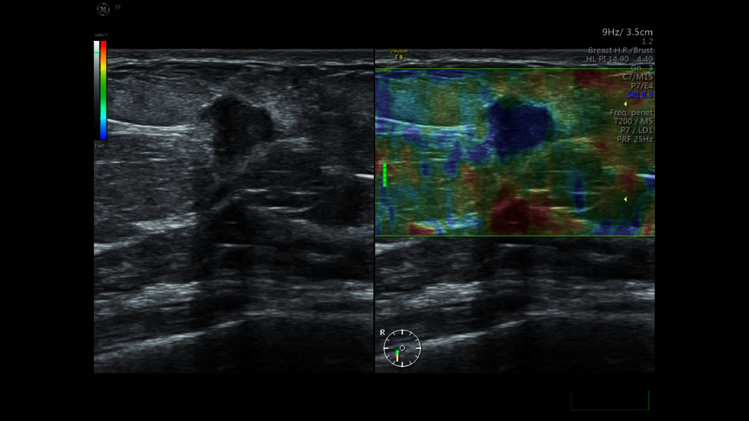 Ultraschallbild Mammasonographie mit Elastographie