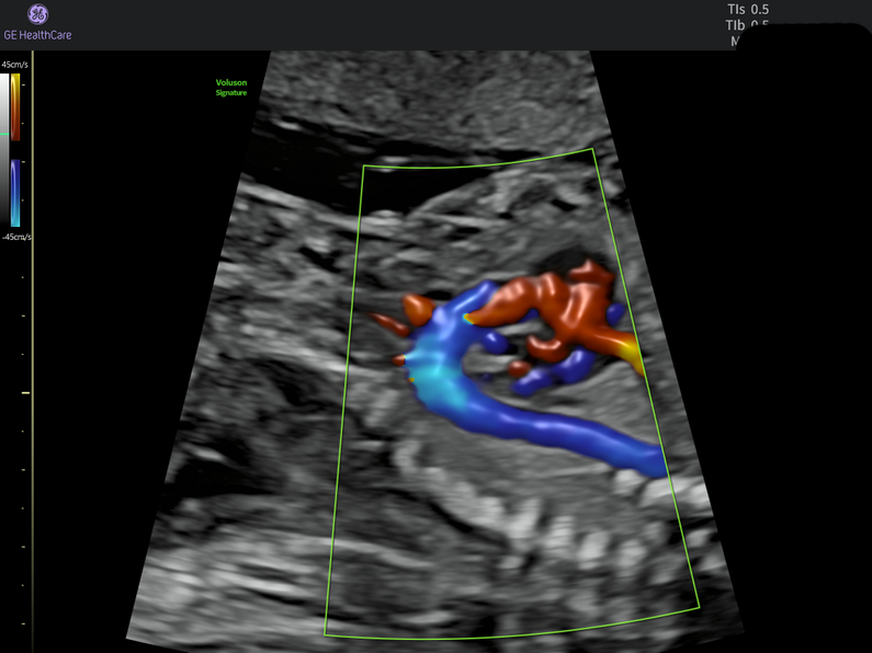 3D-like color Doppler rendering of blood flow shown in red and blue against grayscale ultrasound tissue.