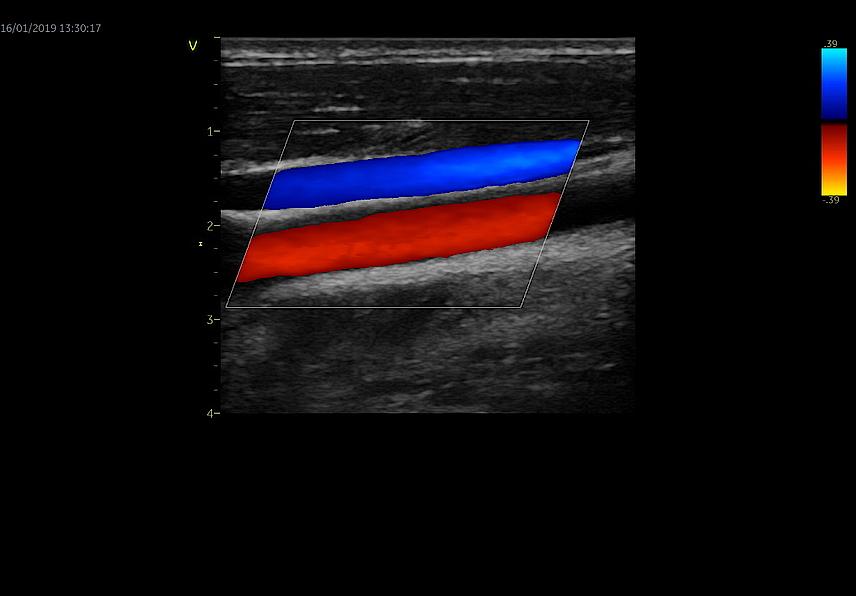 Klinický snímek zachycený během ultrazvukového cévního vyšetření