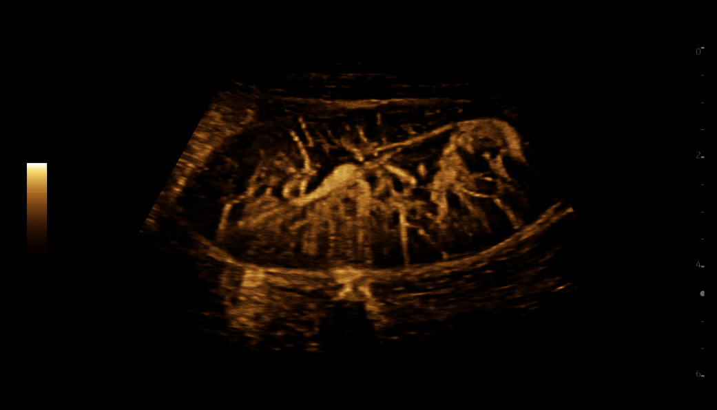 Neonatal brain with MVI & Radiantflow, ML4-20