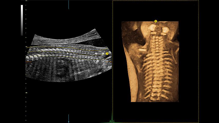 Welcome to easy 3D in 1/2 the time. Simply trace the spine and the system automatically acquires the volume and displays the coronal view - with 83% less keystrokes.