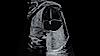 Ultrazvukový snímek čtyřkomorového srdce plodu