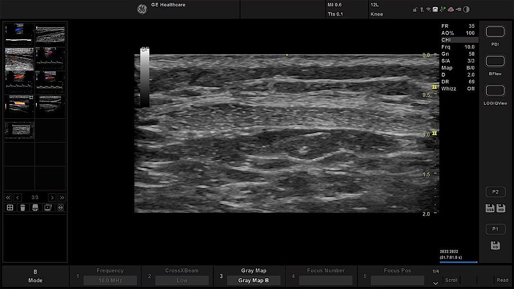 Ultrasound image of patellar tendon