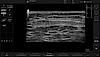 Ultrazvukový snímek paralelní šlachy