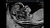 Ultrasound image of a fetus