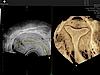Uterine Trace Uterine Trace