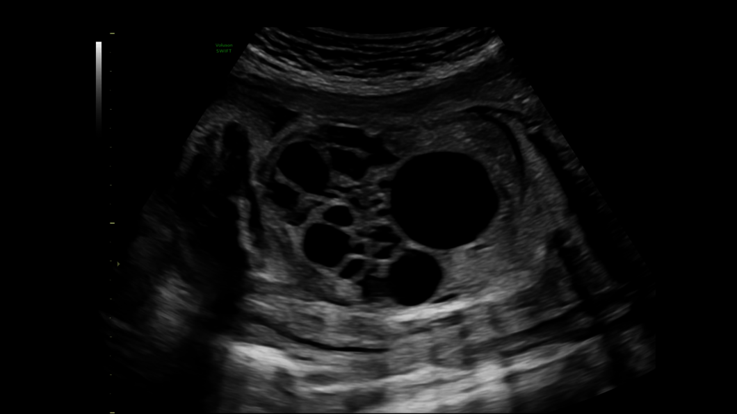 Ultrazvukový snímek multicystické ledviny plodu