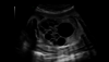Image échographique d'un rein fœtal multikystique