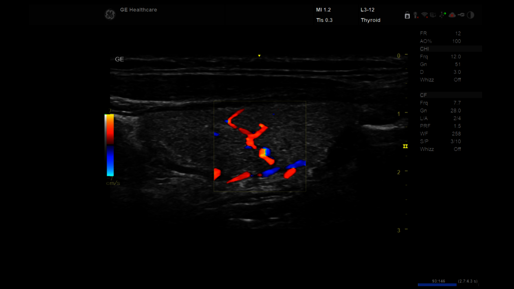 Ultrasound image: Thyroid color long
