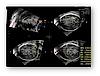 Υπερηχογραφική εικόνα εγκεφάλου του εμβρύου, η οποία λαμβάνεται με χρήση του SonoCNS