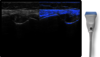 Knee fusion with L6-12 probe