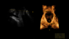 Ultrazvukový snímek: Ultrazvuk pánevního dna