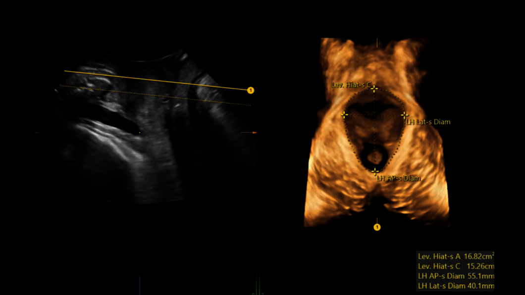 Ultrazvukový snímek: Ultrazvuk pánevního dna