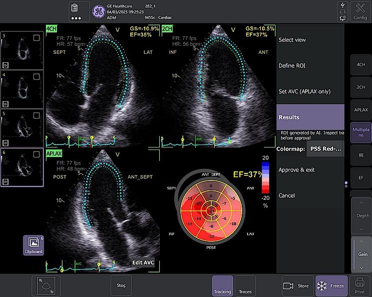 Automated Function Imaging (AFI)