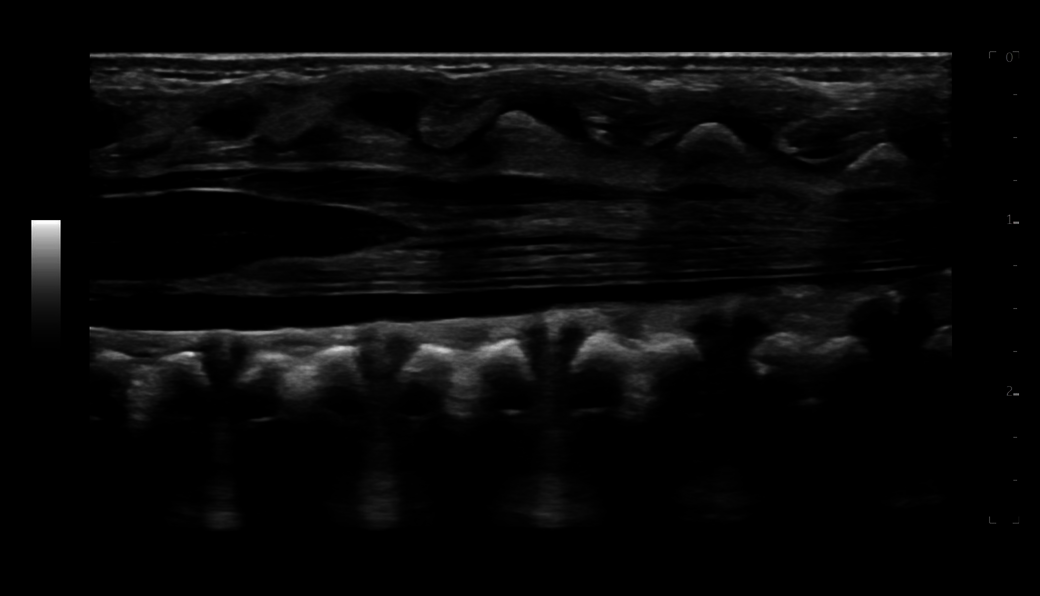 High resolution imaging of neonatal spine, ML4-16-D