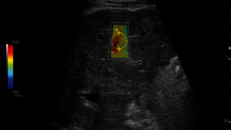 2D Shear Wave Elastography ultrasound image