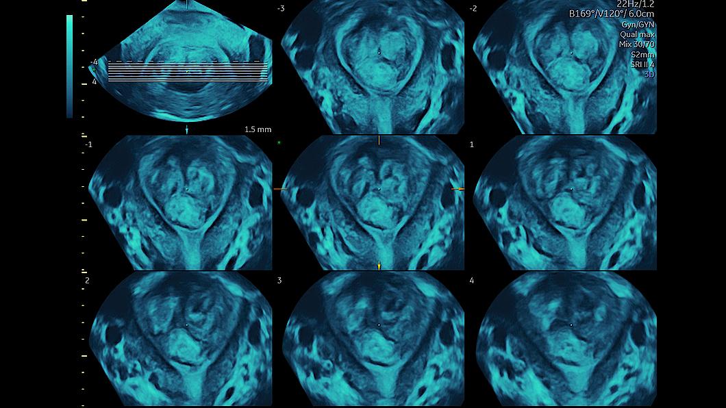 Fibroid