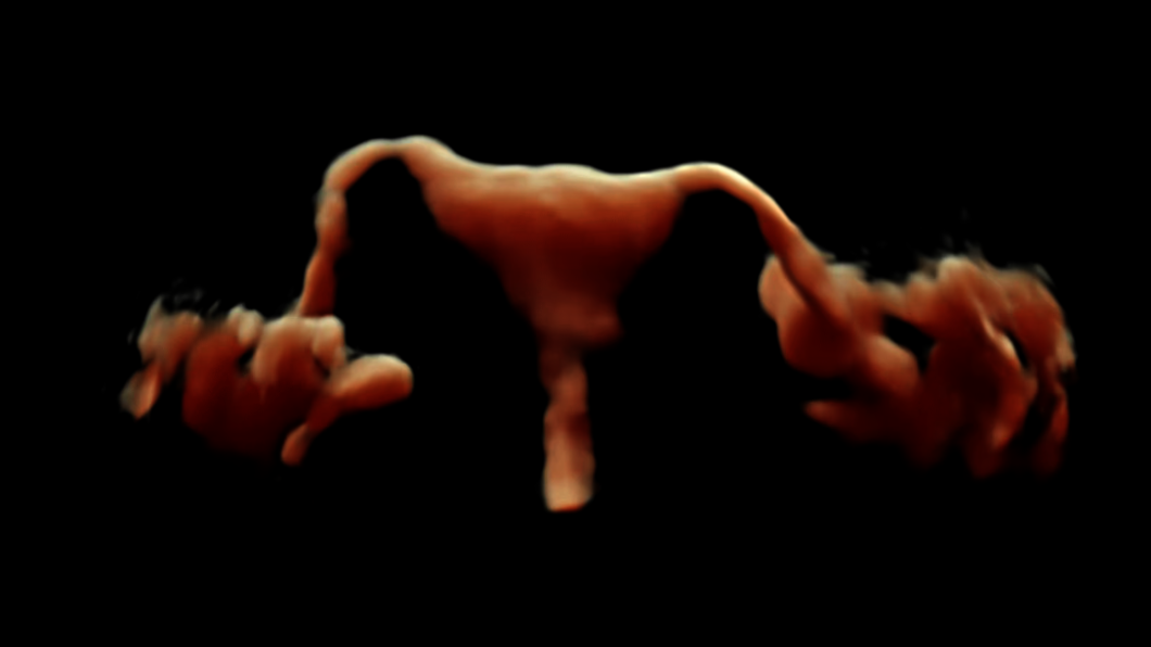 Ultrazvukový snímek: HDlive HyCoSy (kontrastní sonografie dělohy a vejcovodů)