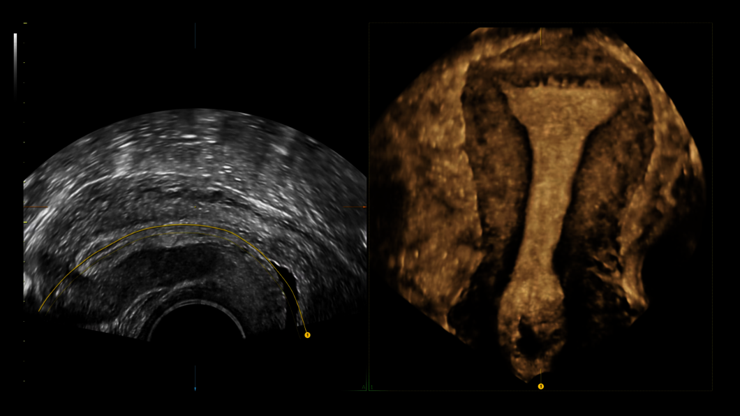 Ultrazvukový snímek: Uterine Trace (sledování dělohy)