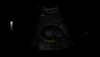 Ultrasound image created by an intraperitoneal scan of kidney, gallbladder and liver.