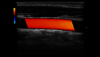 Artera carotidă comună Color Flow, L6-12-RS