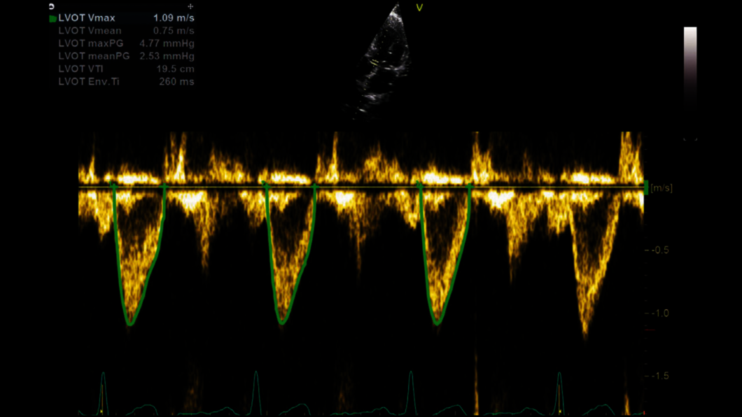 Klinický snímek pořízený pomocí funkce PW-/CW-Doppler