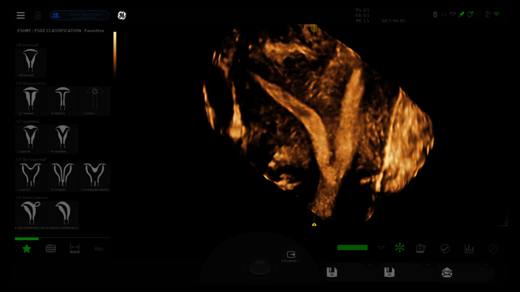 Image échographique : Utérus cloisonné avec les classifications utérines ESHRE | ESGE