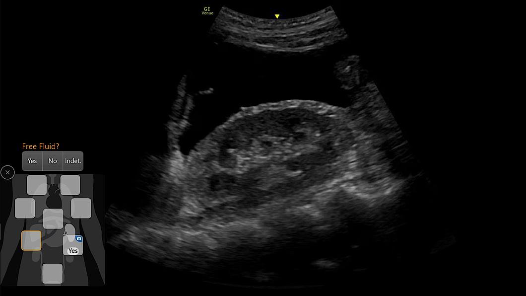 Ultrazvukový snímek zachycený pomocí funkce eFAST