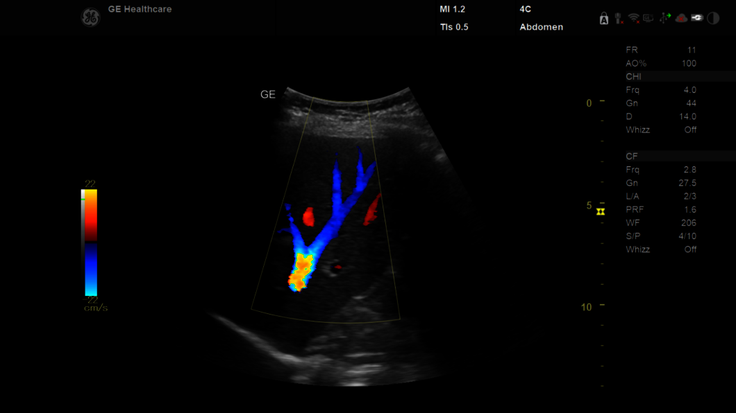 Ultrazvukový snímek: 4C játra v barvě