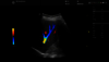 Ultrasound image: 4C liver color
