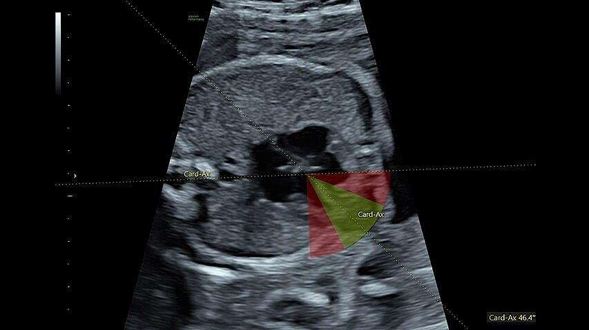 Fetal-hs
