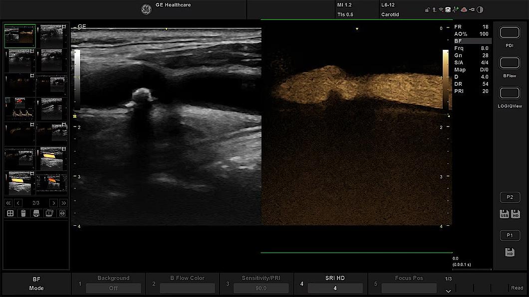 Carotid Artery Dual Screen with B-Flow Color