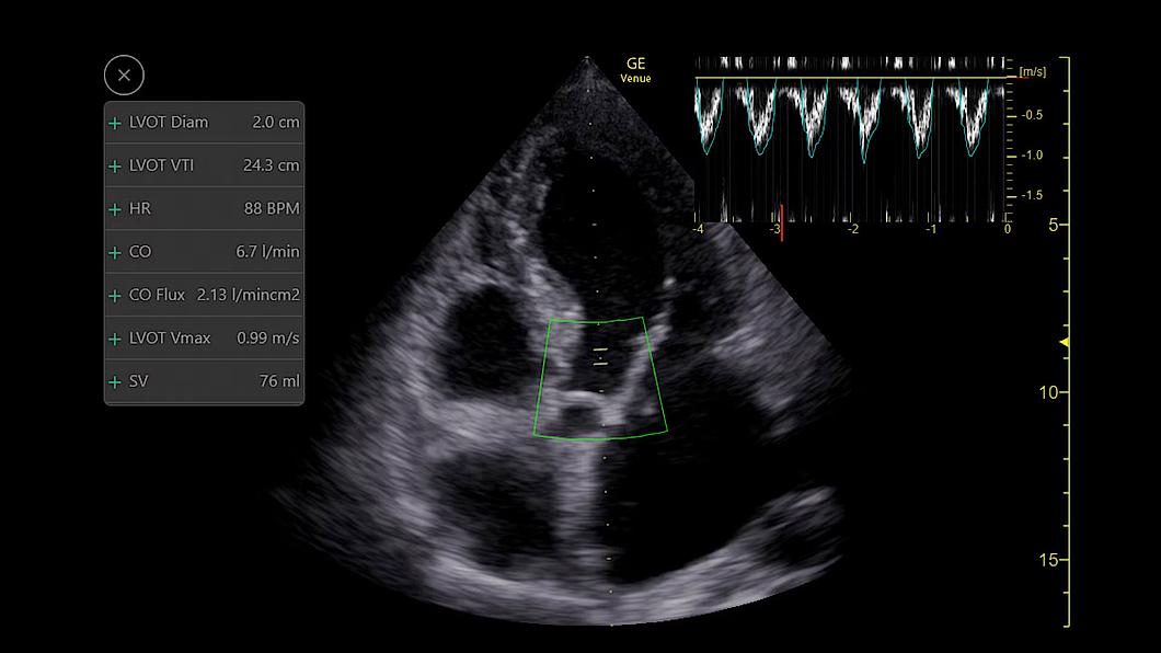 Ultrazvukový snímek zachycený pomocí funkce AUTO VTI