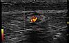 Ultrazvukový snímek cévního vyšetření