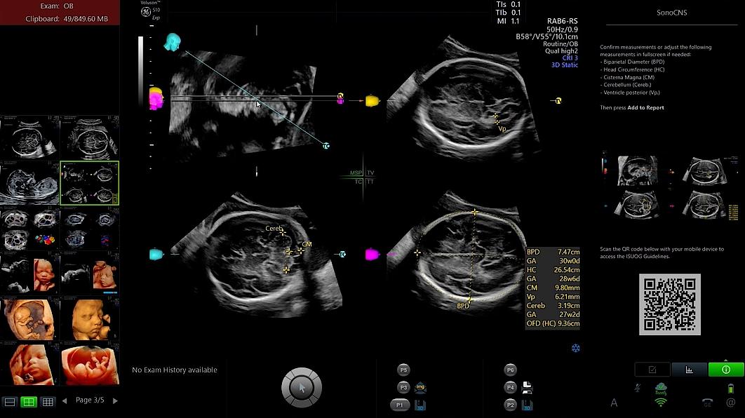 Ultrasound image of the fetal brain captured using SonoCNS