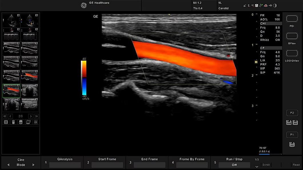 Ultrazvukový snímek a. carotis zachycený s barevným tokem