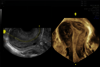 3D ultrazvukový snímek ženské dělohy