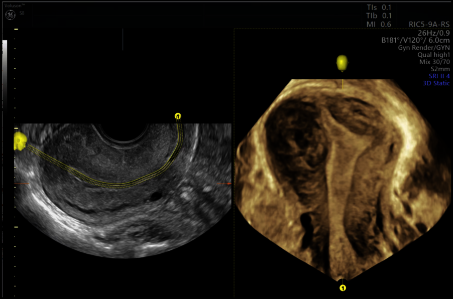 3D ultrazvukový snímek ženské dělohy