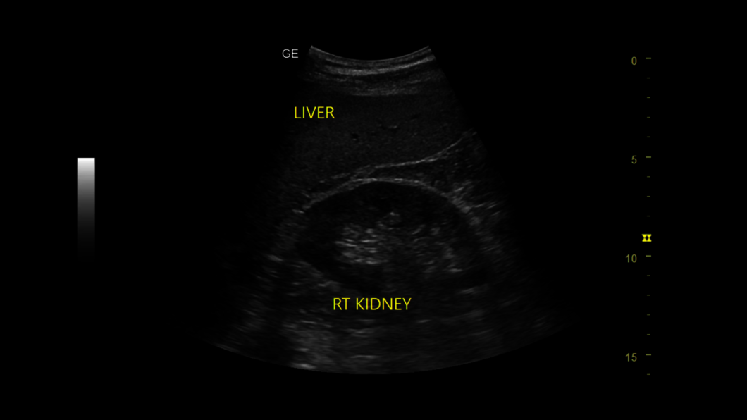 Ultrasound image created by an intraperitoneal scan of kidney, gallbladder and liver.
